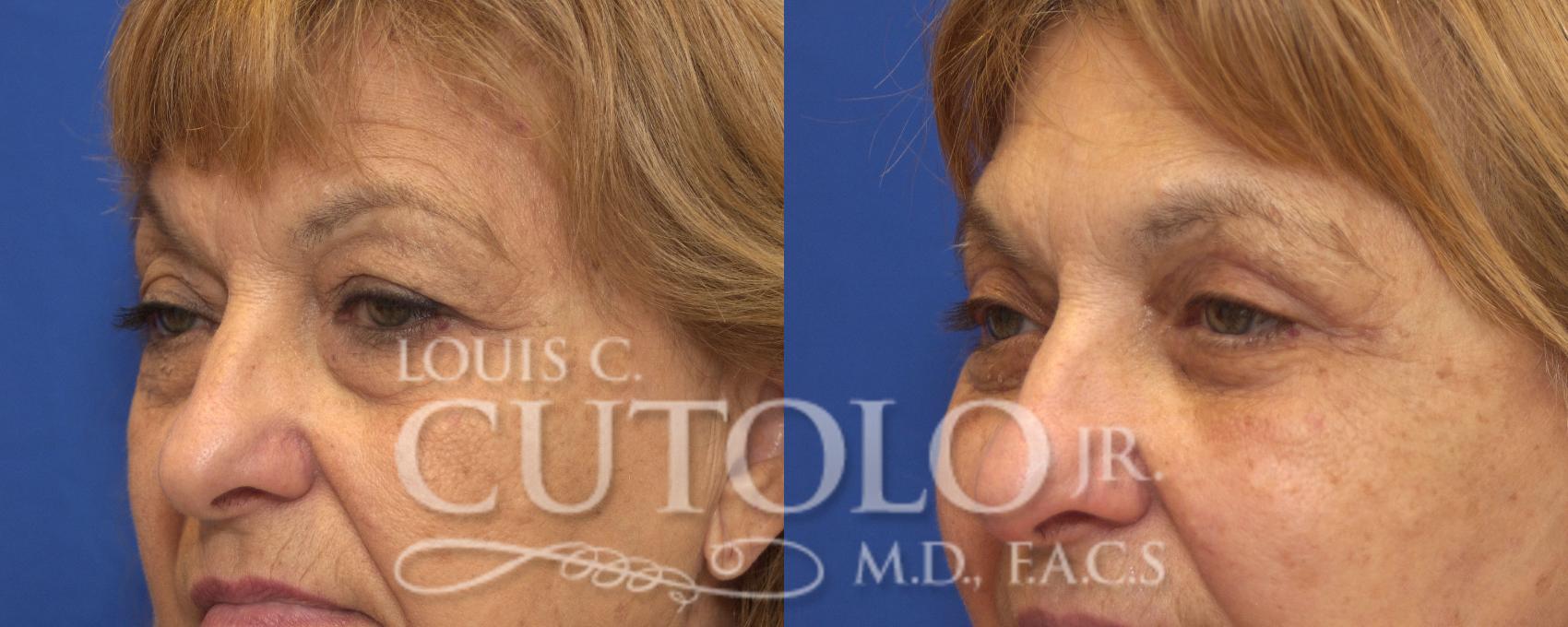 Before & After Eyelid Surgery Case 128 View #2 View in Brooklyn, Staten Island, Queens, NY