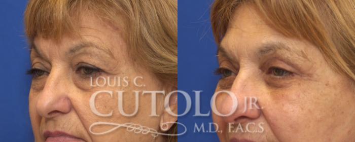 Before & After Eyelid Surgery Case 128 View #2 View in Brooklyn, Staten Island, Queens, NY