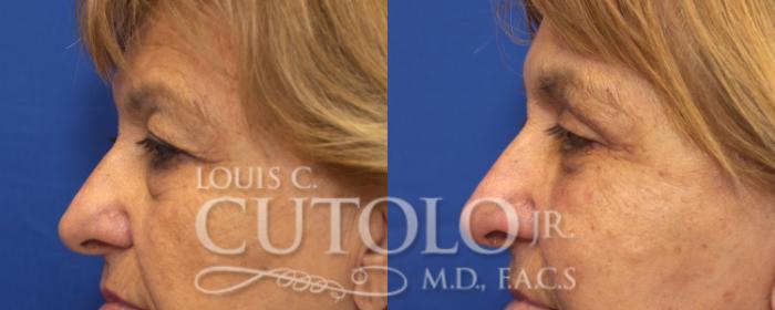 Before & After Eyelid Surgery Case 128 View #3 View in Brooklyn, Staten Island, Queens, NY