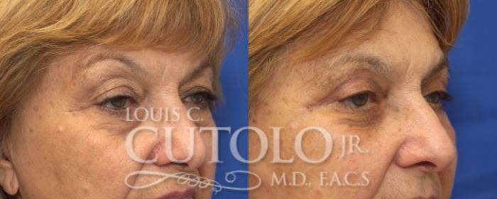 Before & After Eyelid Surgery Case 128 View #4 View in Brooklyn, Staten Island, Queens, NY