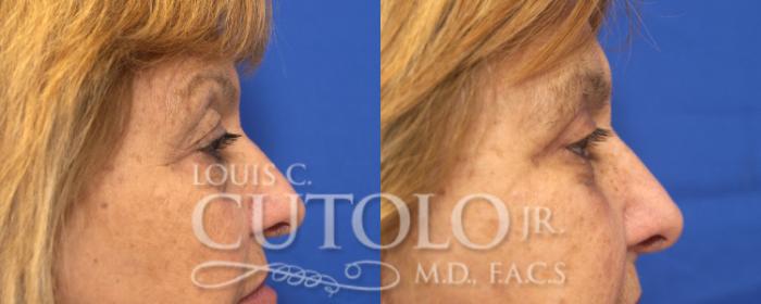 Before & After Eyelid Surgery Case 128 View #5 View in Brooklyn, Staten Island, Queens, NY