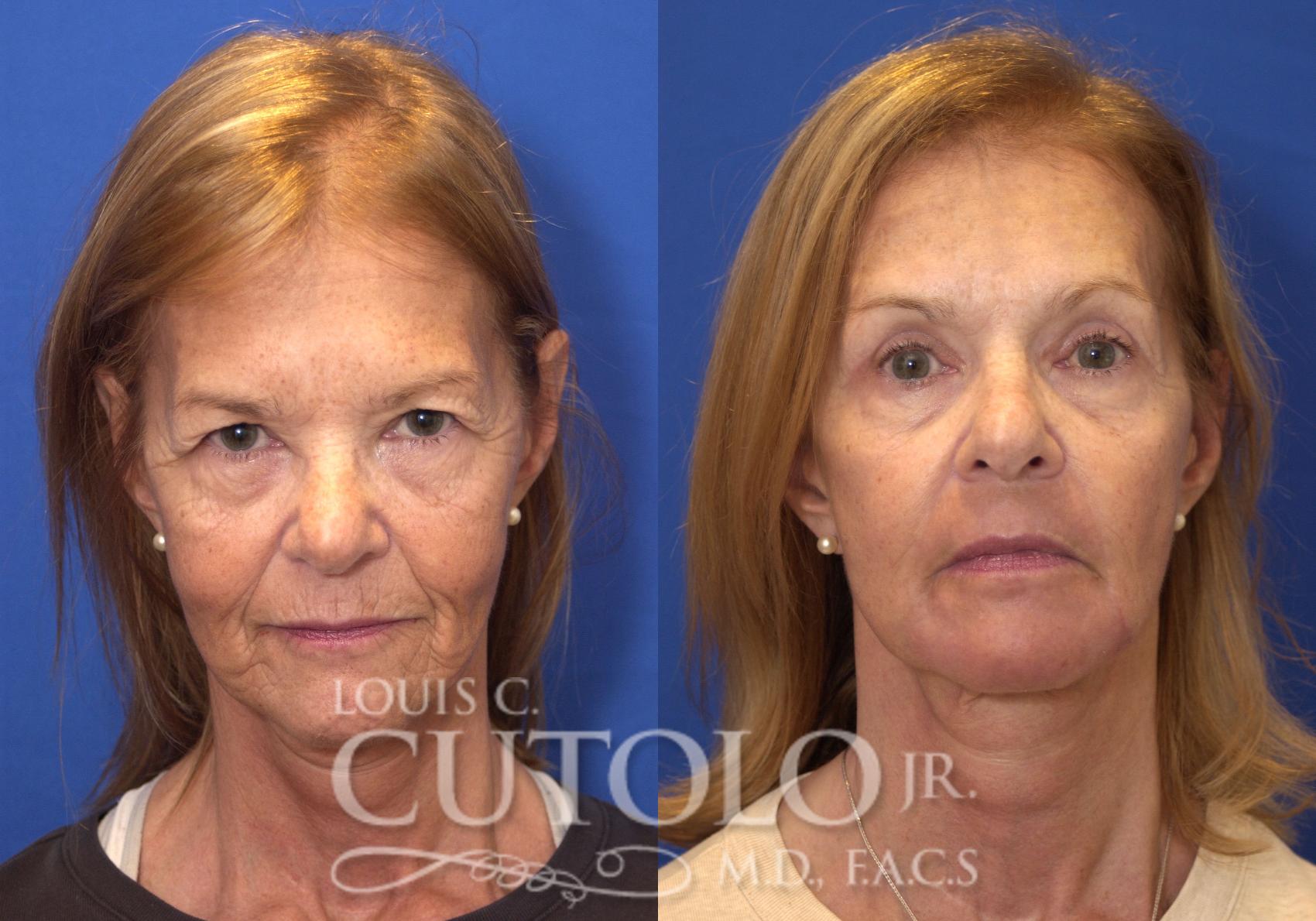 Before & After Eyelid Surgery Case 151 View #1 View in Brooklyn, Staten Island, Queens, NY