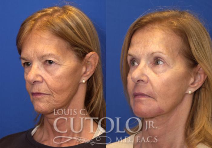 Before & After Eyelid Surgery Case 151 View #2 View in Brooklyn, Staten Island, Queens, NY