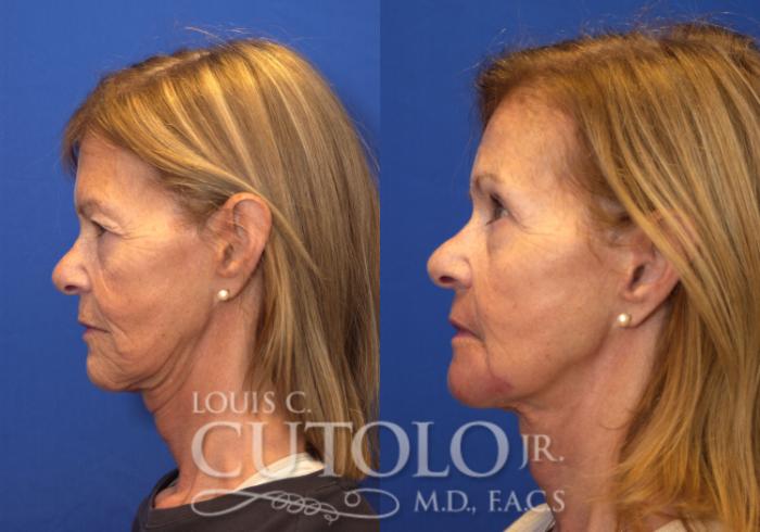Before & After Eyelid Surgery Case 151 View #3 View in Brooklyn, Staten Island, Queens, NY