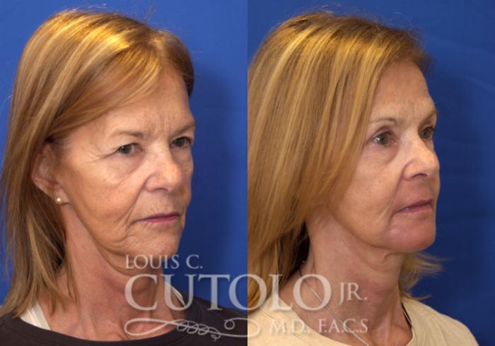 Before & After Eyelid Surgery Case 151 View #4 View in Brooklyn, Staten Island, Queens, NY