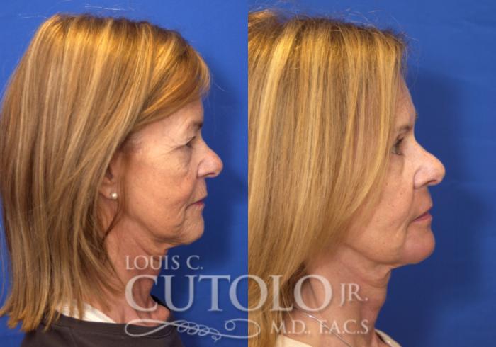 Before & After Eyelid Surgery Case 151 View #5 View in Brooklyn, Staten Island, Queens, NY