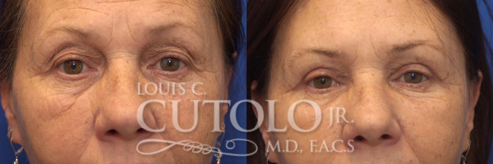 Before & After Eyelid Surgery Case 179 View #1 View in Brooklyn, Staten Island, Queens, NY