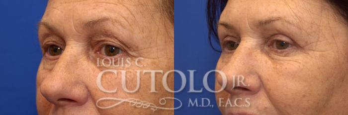 Before & After Eyelid Surgery Case 179 View #2 View in Brooklyn, Staten Island, Queens, NY
