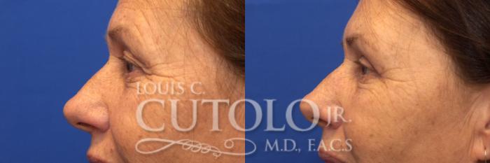 Before & After Eyelid Surgery Case 179 View #3 View in Brooklyn, Staten Island, Queens, NY