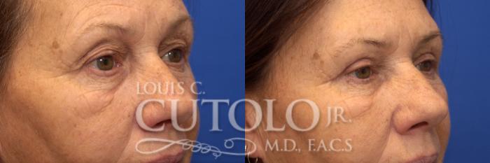 Before & After Eyelid Surgery Case 179 View #4 View in Brooklyn, Staten Island, Queens, NY