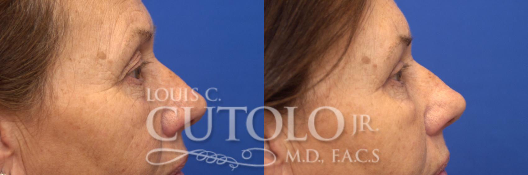 Before & After Eyelid Surgery Case 179 View #5 View in Brooklyn, Staten Island, Queens, NY