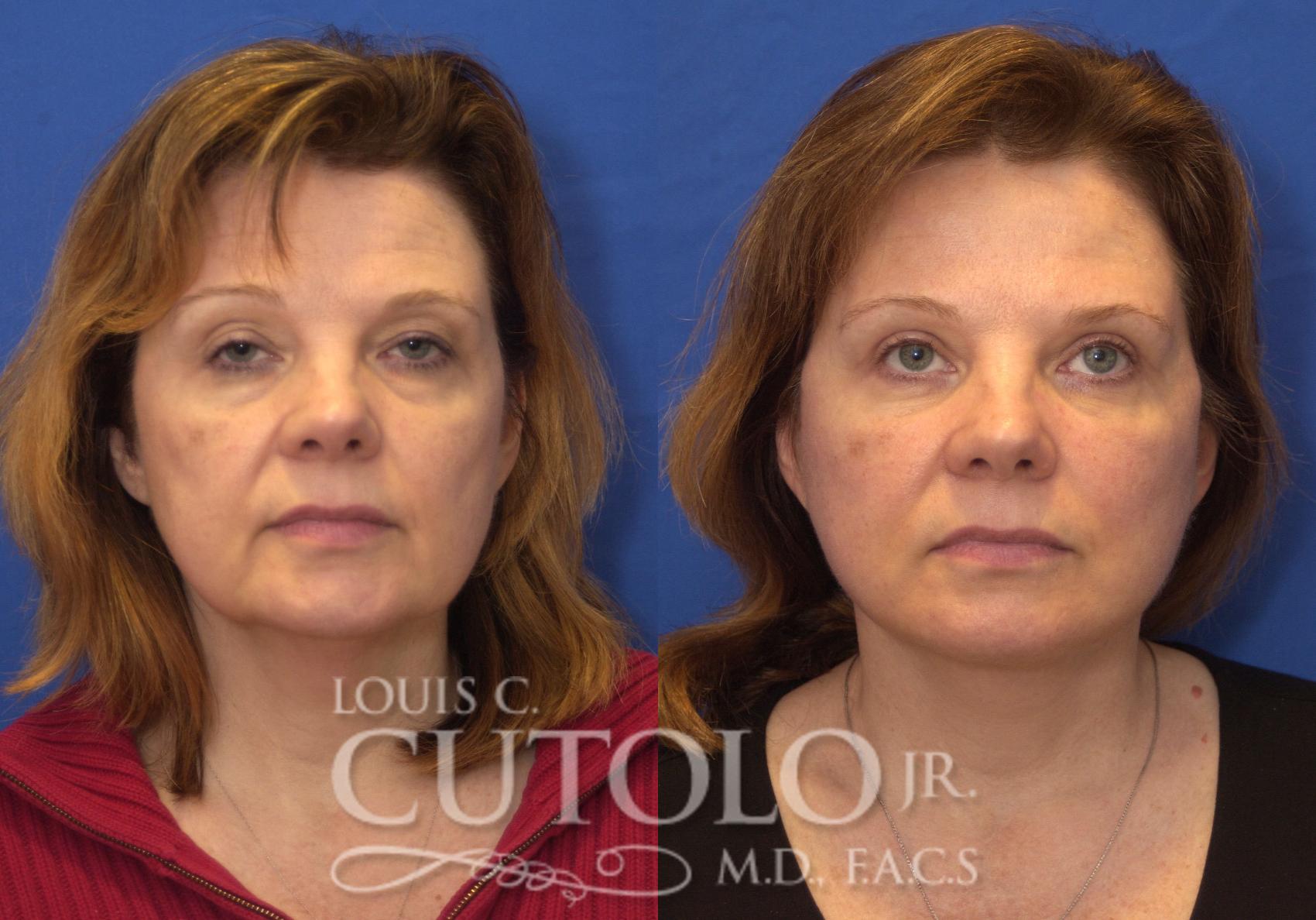 Before & After Eyelid Surgery Case 208 View #1 View in Brooklyn, Staten Island, Queens, NY