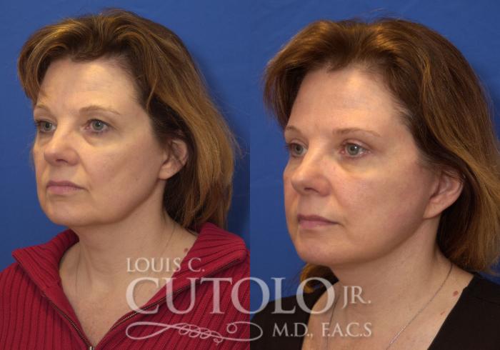 Before & After Eyelid Surgery Case 208 View #2 View in Brooklyn, Staten Island, Queens, NY