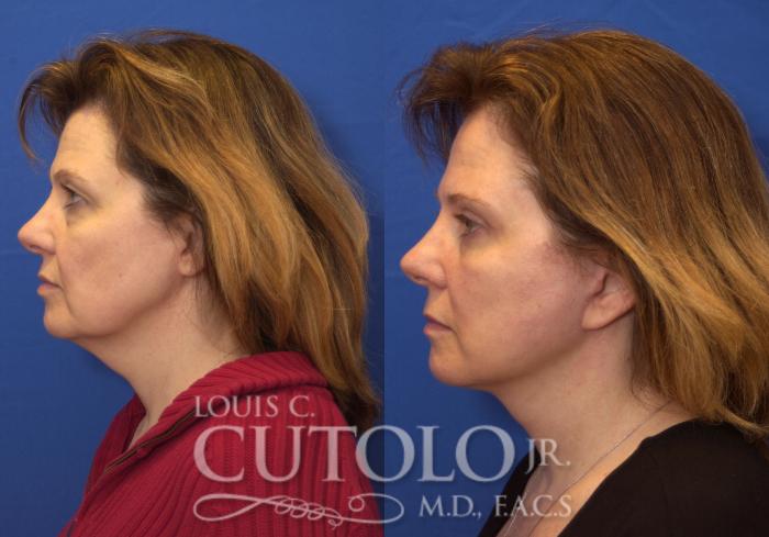 Before & After Eyelid Surgery Case 208 View #3 View in Brooklyn, Staten Island, Queens, NY