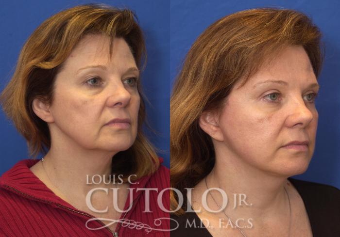 Before & After Eyelid Surgery Case 208 View #4 View in Brooklyn, Staten Island, Queens, NY