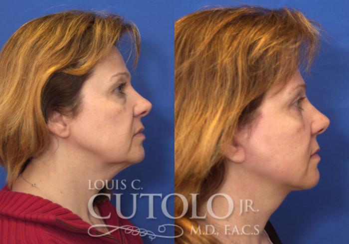 Before & After Eyelid Surgery Case 208 View #5 View in Brooklyn, Staten Island, Queens, NY