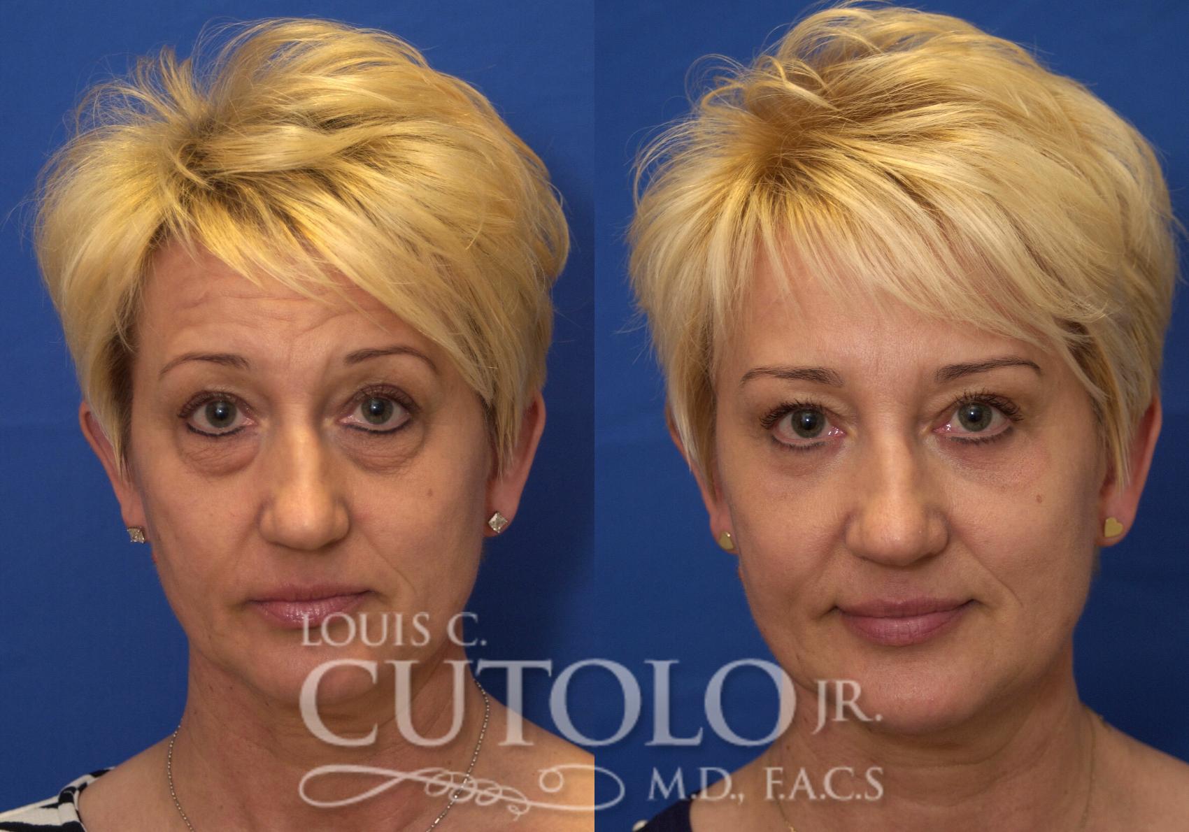 Before & After Eyelid Surgery Case 217 View #1 View in Brooklyn, Staten Island, Queens, NY