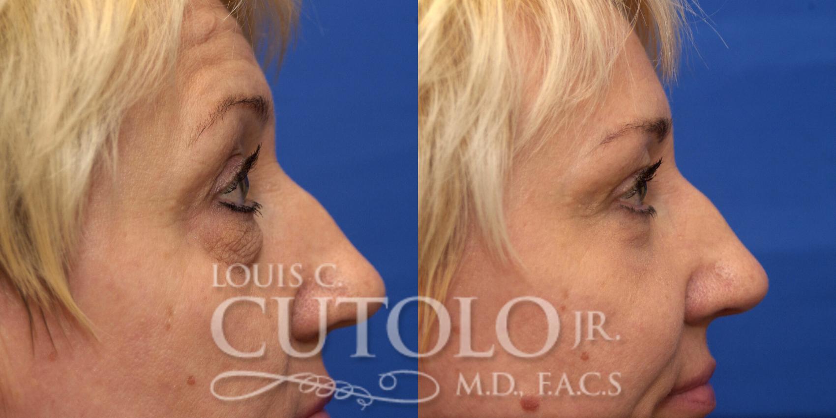 Before & After Eyelid Surgery Case 217 View #10 View in Brooklyn, Staten Island, Queens, NY