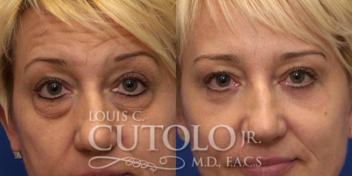 Before & After Eyelid Surgery Case 217 View #2 View in Brooklyn, Staten Island, Queens, NY