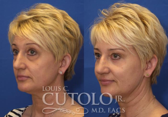Before & After Eyelid Surgery Case 217 View #3 View in Brooklyn, Staten Island, Queens, NY