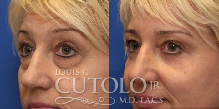 Before & After Eyelid Surgery Case 217 View #4 View in Brooklyn, Staten Island, Queens, NY