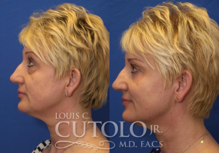 Before & After Eyelid Surgery Case 217 View #5 View in Brooklyn, Staten Island, Queens, NY