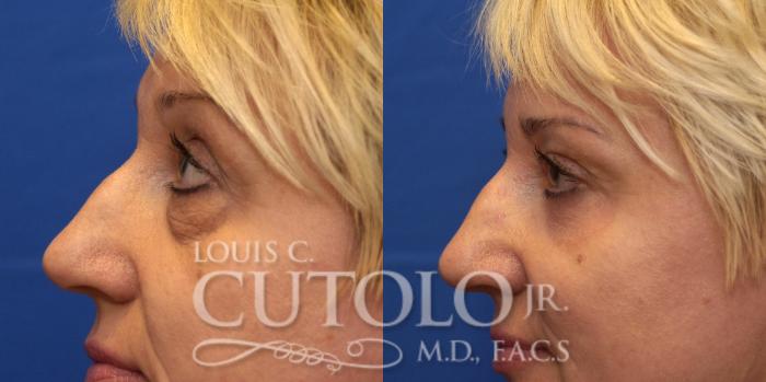 Before & After Eyelid Surgery Case 217 View #6 View in Brooklyn, Staten Island, Queens, NY