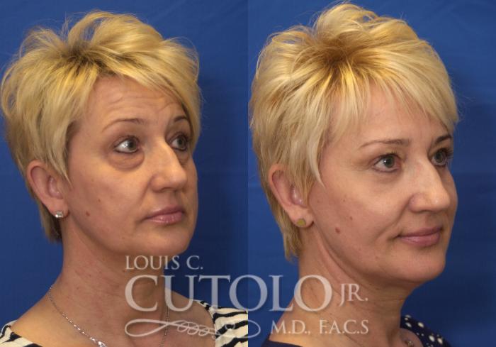 Before & After Eyelid Surgery Case 217 View #7 View in Brooklyn, Staten Island, Queens, NY