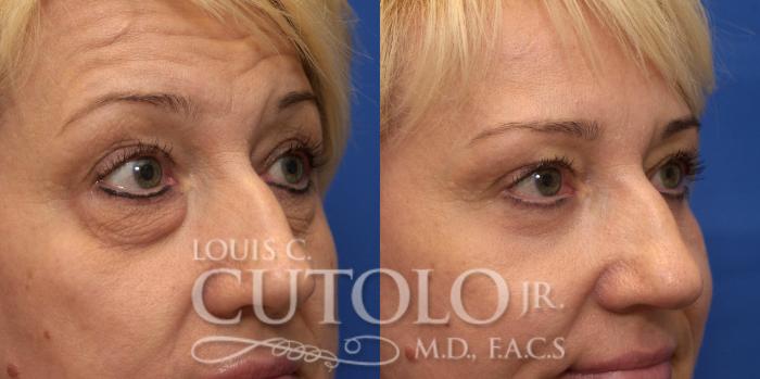 Before & After Eyelid Surgery Case 217 View #8 View in Brooklyn, Staten Island, Queens, NY