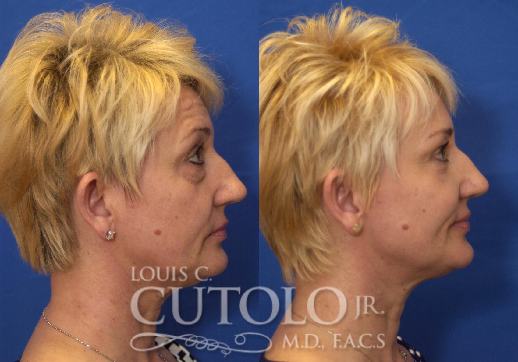 Before & After Eyelid Surgery Case 217 View #9 View in Brooklyn, Staten Island, Queens, NY