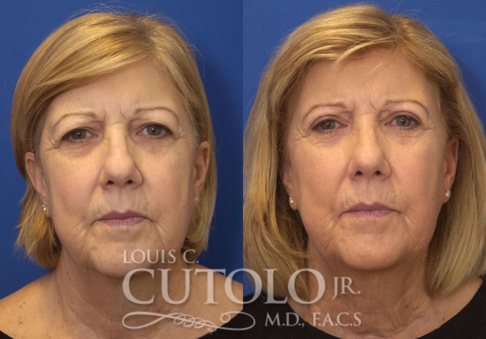 Before & After Eyelid Surgery Case 225 View #1 View in Brooklyn, Staten Island, Queens, NY