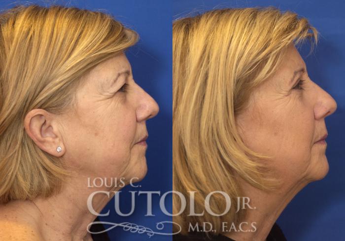Before & After Eyelid Surgery Case 225 View #10 View in Brooklyn, Staten Island, Queens, NY