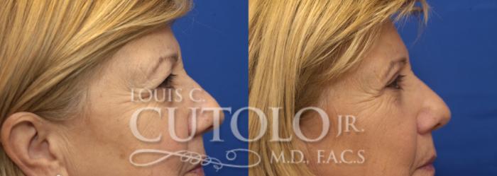 Before & After Eyelid Surgery Case 225 View #11 View in Brooklyn, Staten Island, Queens, NY