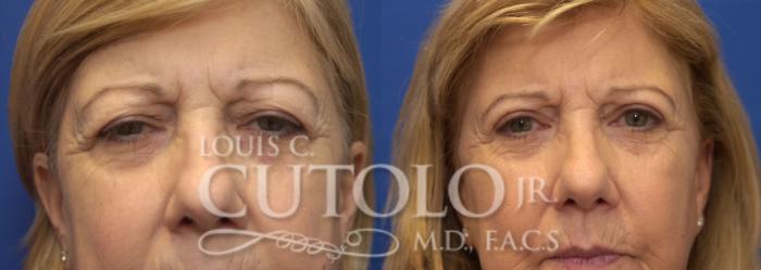 Before & After Eyelid Surgery Case 225 View #2 View in Brooklyn, Staten Island, Queens, NY
