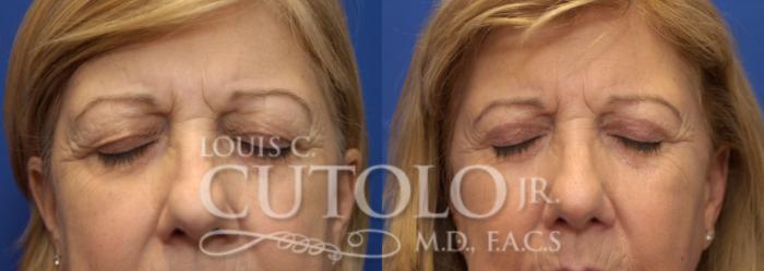 Before & After Eyelid Surgery Case 225 View #3 View in Brooklyn, Staten Island, Queens, NY