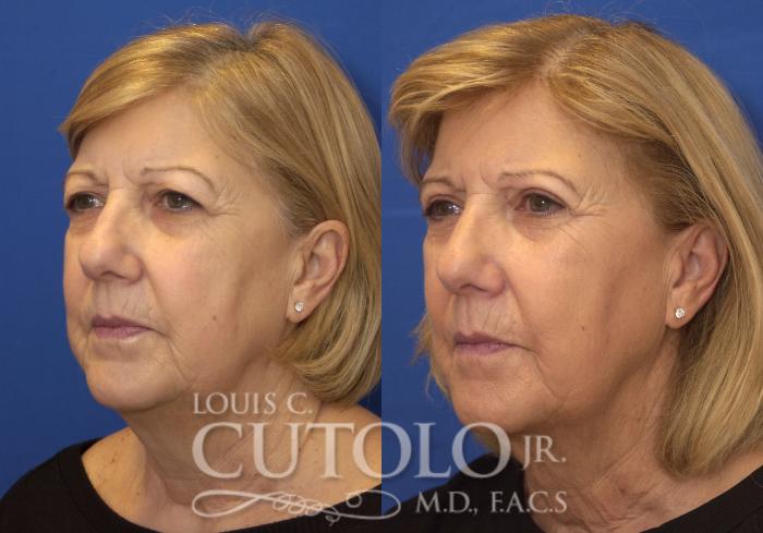 Before & After Eyelid Surgery Case 225 View #4 View in Brooklyn, Staten Island, Queens, NY