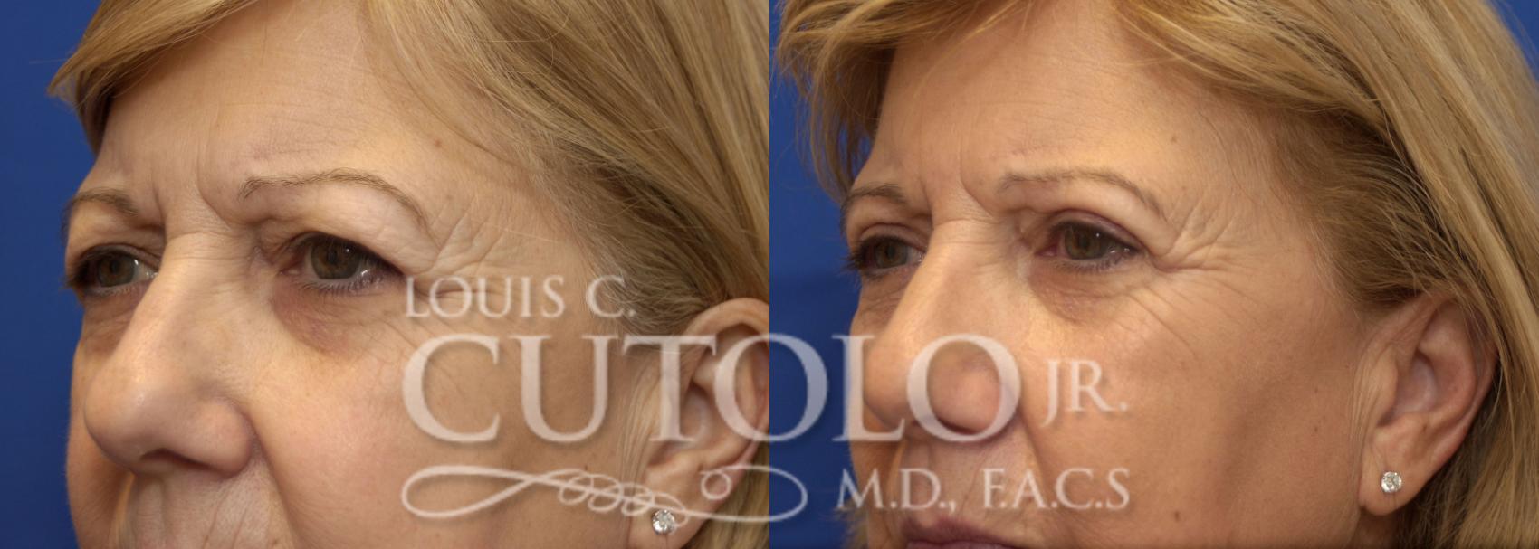 Before & After Eyelid Surgery Case 225 View #5 View in Brooklyn, Staten Island, Queens, NY