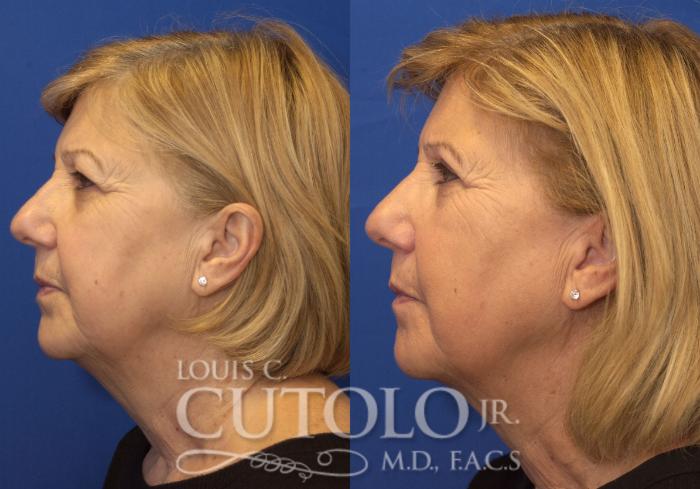 Before & After Eyelid Surgery Case 225 View #6 View in Brooklyn, Staten Island, Queens, NY