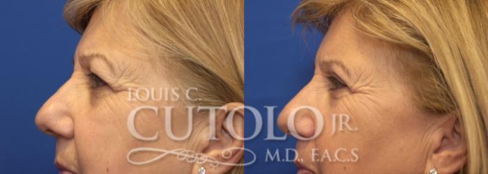 Before & After Eyelid Surgery Case 225 View #7 View in Brooklyn, Staten Island, Queens, NY