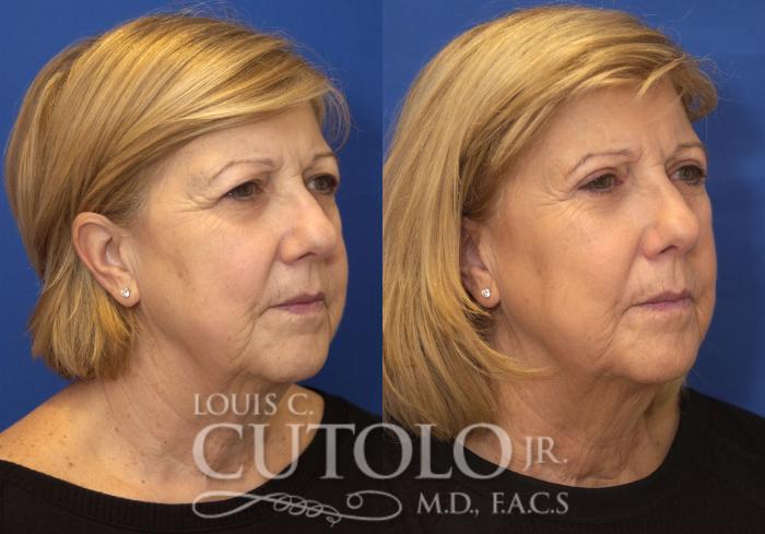 Before & After Eyelid Surgery Case 225 View #8 View in Brooklyn, Staten Island, Queens, NY