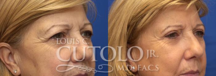 Before & After Eyelid Surgery Case 225 View #9 View in Brooklyn, Staten Island, Queens, NY