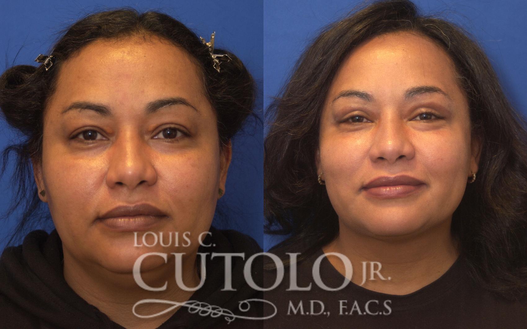 Before & After Eyelid Surgery Case 248 Front View in Brooklyn, Staten Island, Queens, NY
