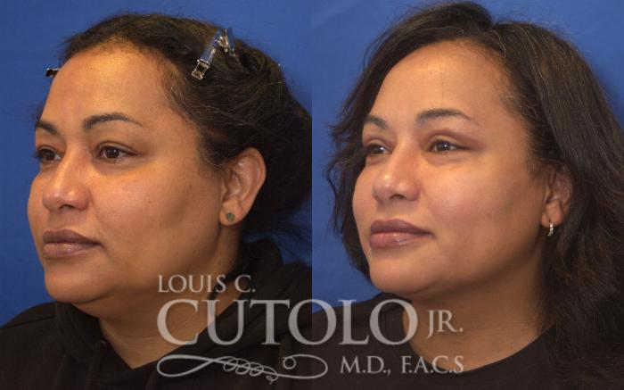 Before & After Liposuction Case 248 Left Oblique View in Brooklyn, Staten Island, Queens, NY