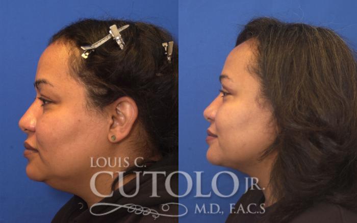 Before & After Liposuction Case 248 Left Side View in Brooklyn, Staten Island, Queens, NY