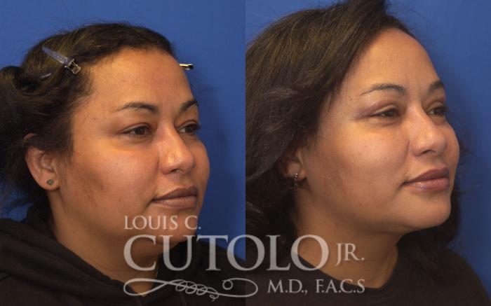 Before & After Eyelid Surgery Case 248 Right Oblique View in Brooklyn, Staten Island, Queens, NY