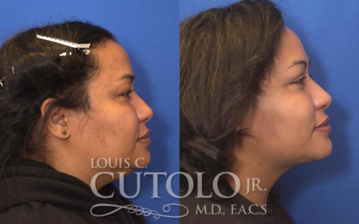 Before & After Eyelid Surgery Case 248 Right Side View in Brooklyn, Staten Island, Queens, NY
