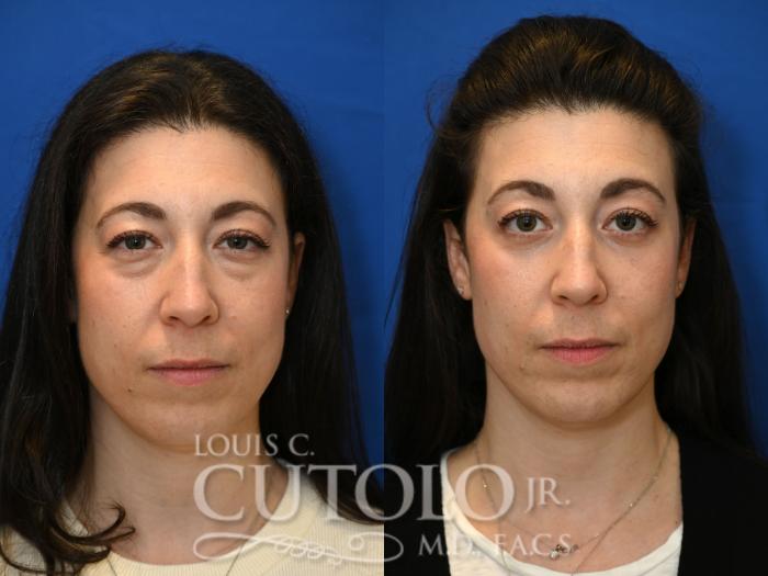 Anterior before