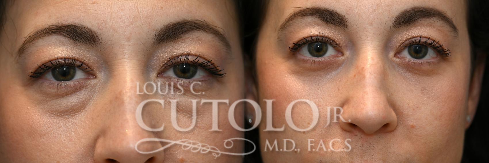 Anterior before
