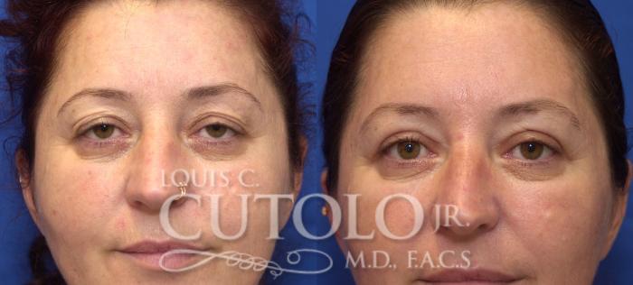 Before & After Eyelid Surgery Case 45 View #1 View in Brooklyn, Staten Island, Queens, NY