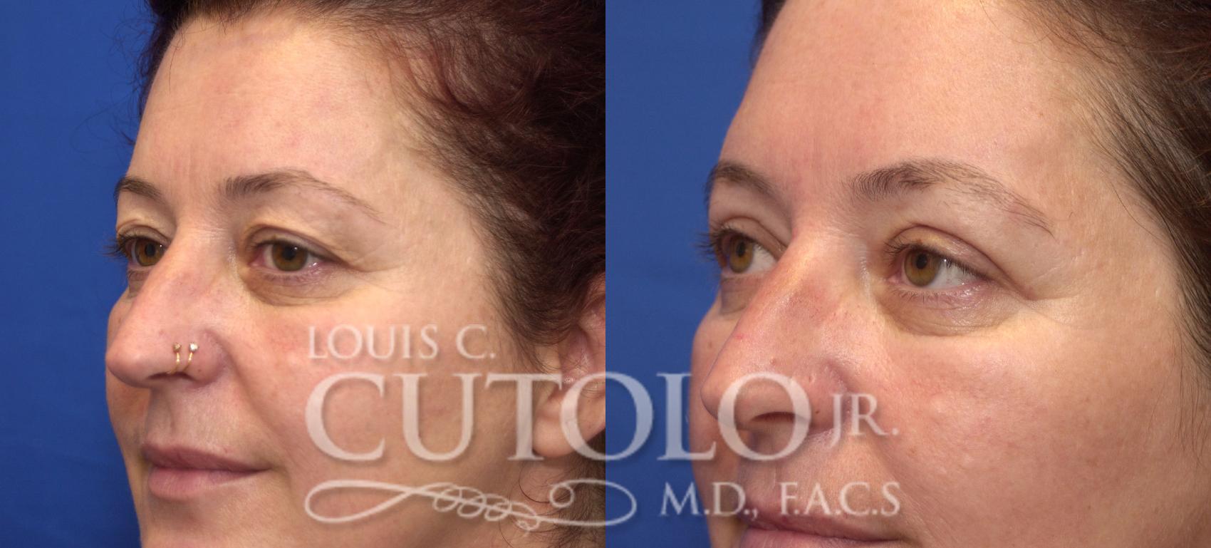 Before & After Eyelid Surgery Case 45 View #2 View in Brooklyn, Staten Island, Queens, NY